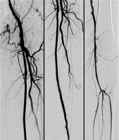 Abbildung 3: Ballondilatation