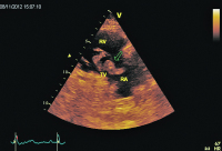 Abbildung 2: Rechtsventrikulärer Einflusstrakt