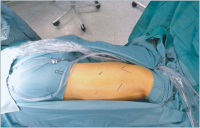 Abbildung 2: Inzision