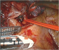 Abbildung 4: VATS-Lobektomie