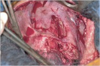 Abbildung 1: Lymphadenektomie