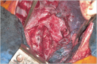 Abbildung 2: Lymphadenektomie