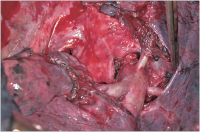 Abbildung 3: Lymphadenektomie 