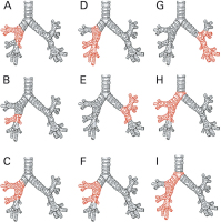Abbildung 2a-i: Manschetten-/Sleeve-Resektion