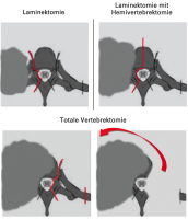 Abbildung 3: Resektion