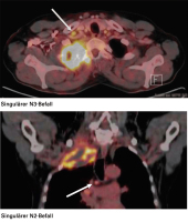 Abbildung 5: N3-Lymphknoten