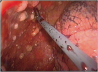 Abbildung 1: Biopsie