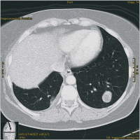 Abbildung 1: Thorax-CT