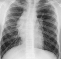 Abbildung 1: Thoraxröntgen