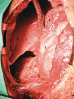 Abbildung 3: Thymus - Resektion
