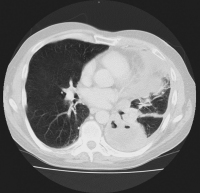 Abbildung 1: Thorax-CT