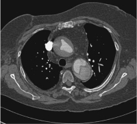 Abbildung 2: Aortendissektion