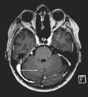 Abbildung 2: Meningeosis carcinomatosa