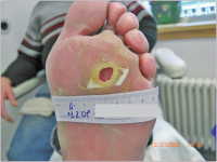 Abbildung 1: Diabetisches Fußsyndrom