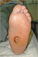 Abbildung 2: Diabetisches Fußsyndrom