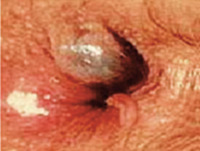 Abbildung 1: Hämorrhoiden