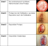 Abbildung 2: Hämorrhoiden