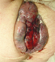 Abbildung 4: Hämorrhoiden