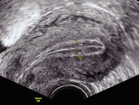 Abbildung 1: Gyn-Ultraschall