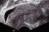 Abbildung 3: Gyn-Ultraschall