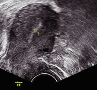 Abbildung 4: Gyn-Ultraschall