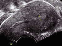 Abbildung 5: Gyn-Ultraschall