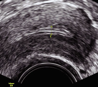 Abbildung 6: Gyn-Ultraschall