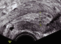 Abbildung 7: Gyn-Ultraschall