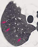 Abbildung 1: Computertomographie-COPD