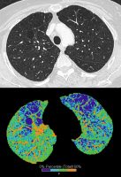 Abbildung 2: Computertomographie-COPD