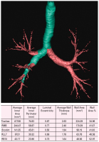Abbildung 4: Computertomographie-COPD