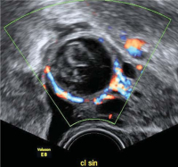 Abbildung 2: Gyn-Ultraschall