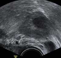 Abbildung 4: Gyn-Ultraschall