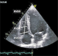 Abbildung 1: Rechtsherzdilatation