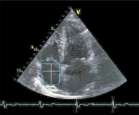 Abbildung 2: Rechtes Atrium