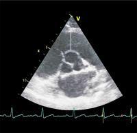 Abbildung 4: RVOT
