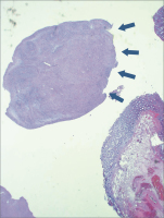 Abbildung 2: Submukosaler Tumor