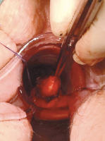 Abbildung 5: Submukosaler Tumor