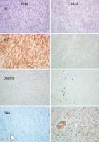 Abbildung 7: Submukosaler Tumor