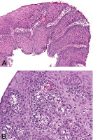 Abbildung 1a-b: Refluxkrankheit