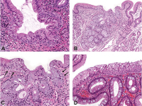 Abbildung 2a-d: Barrett-Ösophagus