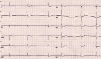 Abbildung 1: Bradyarrhythmia absoluta