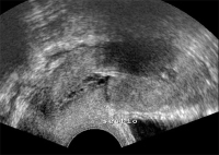 Abbildung 1: Gyn-Ultraschall