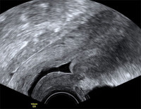 Abbildung 3: Gyn-Ultraschall