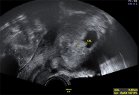 Abbildung 6: Gyn-Ultraschall
