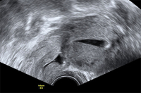 Abbildung 8: Gyn-Ultraschall