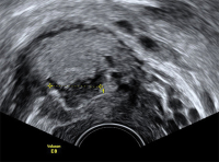 Abbildung 9: Gyn-Ultraschall