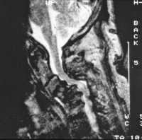 Abbildung 4: Rheumatische Wirbelsäule