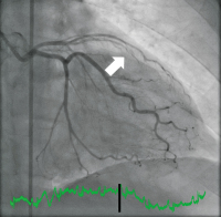 Abbildung 1: Koronarangiographie