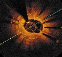 Abbildung 5: ISR - Metall-DES